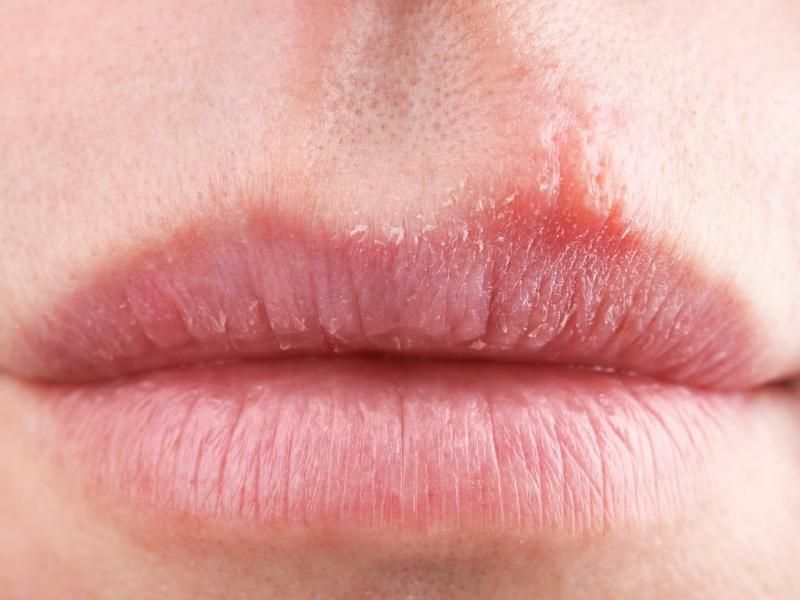 Uống nước đều đặn mỗi ngày rất cần thiết để hồi phục vùng da môi