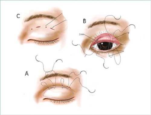 Mọi khiếm khuyết của vùng mắt sẽ được khắc phục sau 20 phút - Nên cắt mí hay nhấn mí