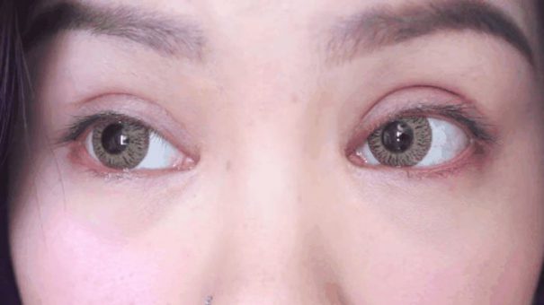 Nguyên nhân cắt mí hỏng thường là do gặp phải cơ sở thẩm mỹ kém chất lượng