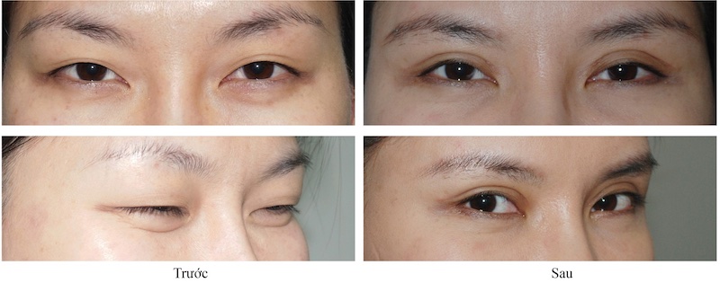 Chỉ tự tiêu thường tồn tại trong cơ thể 1 – 2 tuần trước khi tan hoàn toàn