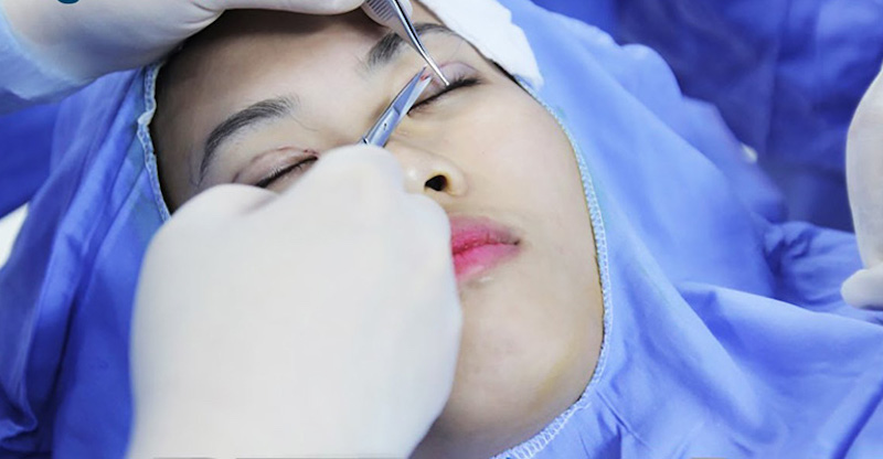 Nhấn mí bằng chỉ là phương pháp thẩm mỹ an toàn tuyệt đối