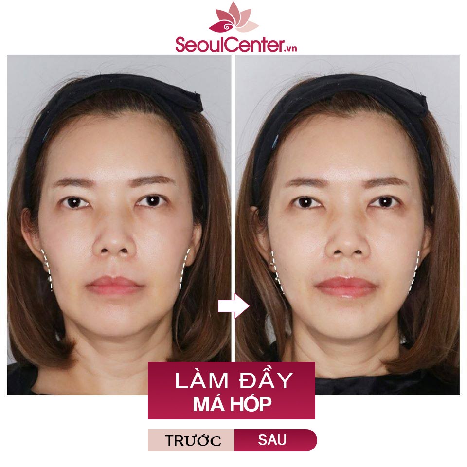 Hình ảnh thực tế của khách hàng sau khi áp dụng tiêm filler làm đầy má hóp