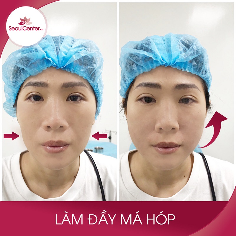 Tiêm filler làm đầy má hóp an toàn khi thực hiện ở địa chỉ uy tín
