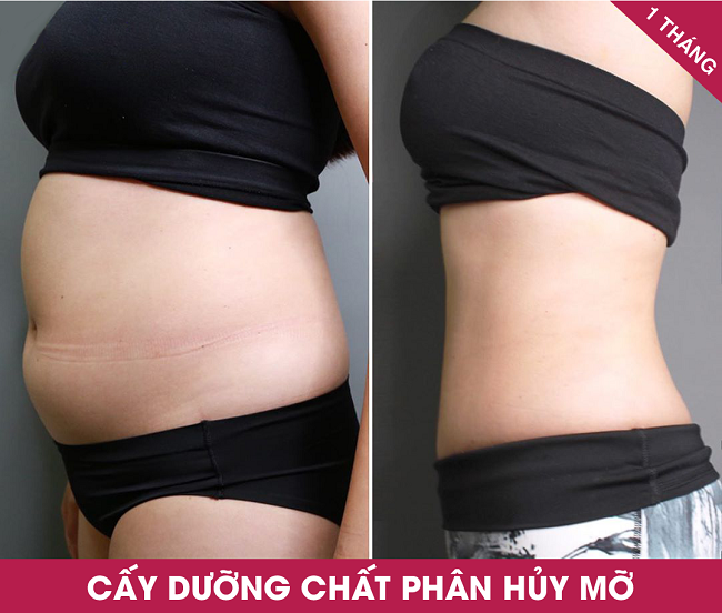 Khách hàng sau khi sử dụng dịch vụ giảm béo