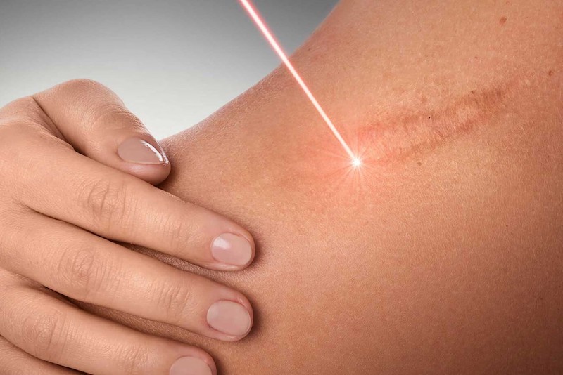 Xóa sẹo lồi bằng laser có mức giá từ 1 – 3 triệu đồng cho 1 lần điều trị