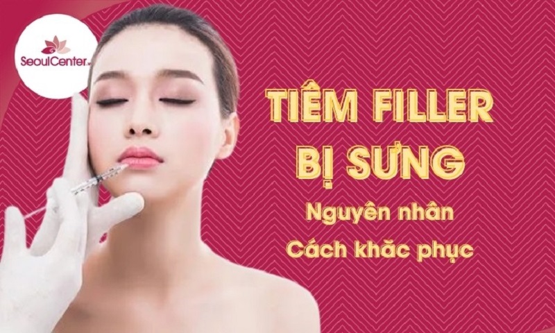 Tiêm filler có bị sưng không là câu hỏi được nhiều người quan tâm