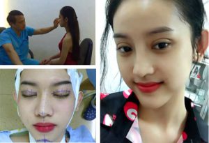 Cắt mí mili deep tạo mắt hai mí đẹp tự nhiên