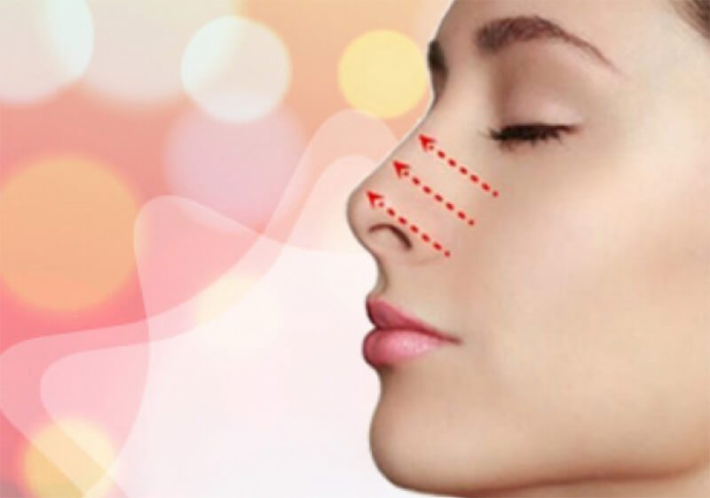 Tiêm filler mũi được bao lâu phụ thuộc vào nhiều yếu tố khác nhau