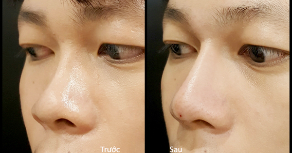 Dáng mũi cao thẳng tự nhiên sau khi tiêm Filler