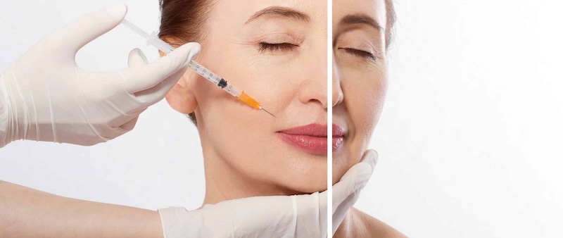 Các loại Filler có chi phí từ 3 – 10 triệu đồng và có thể duy trì được từ 3 – 5 năm