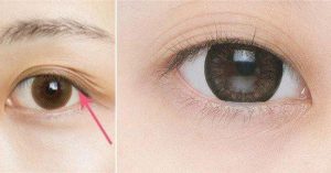 Khái niệm Mắt mí lót