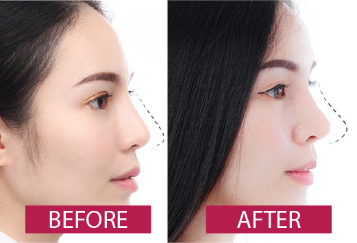 Kết quả thực tế sau khi áp dụng phương pháp tiêm Filler mũi tại thẩm mỹ viện Seoul Center
