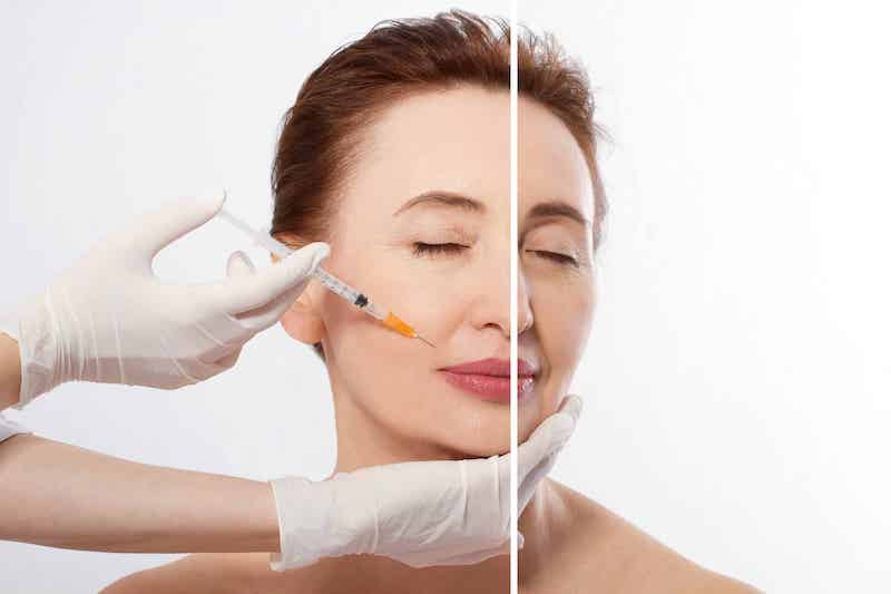 Tiêm filler giúp xóa bỏ nếp nhăn nhanh chóng, hiệu quả và không gây đau đớn