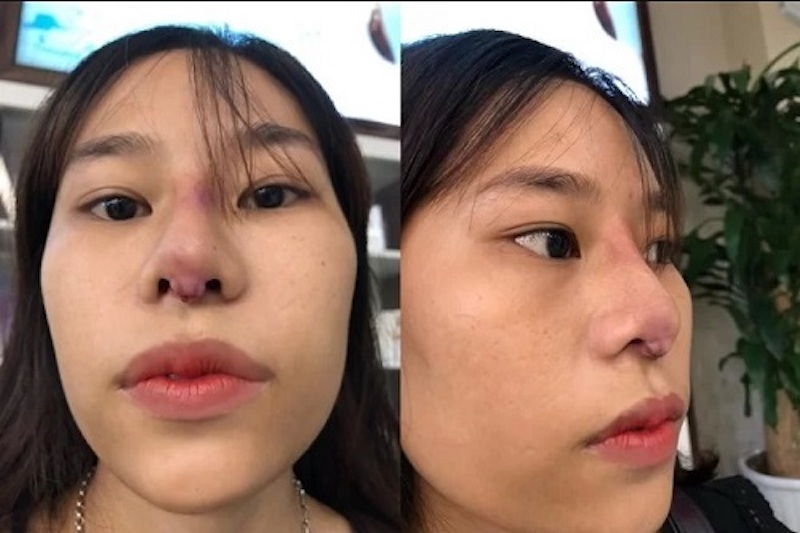 Sẹo lồi ở mũi gây ảnh hưởng xấu đến tính thẩm mỹ trên khuôn mặt