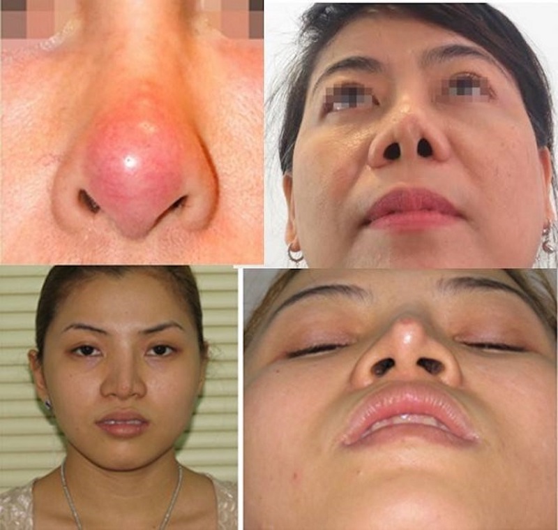 Những biến chứng sau nâng mũi để lại các vết sẹo lồi