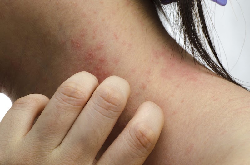 Hiện tượng da bị nổi mẩn đỏ ngứa