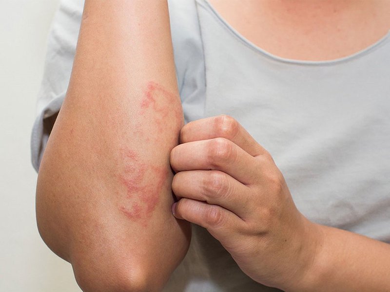 Da bị nổi mẩn đỏ khiến bạn thấy ngứa ngáy khó chịu