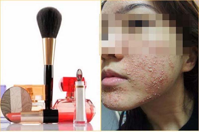 Dị ứng với mỹ phẩm khiến da mẩn đỏ