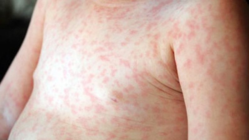 Mẩn đỏ ngứa do các bệnh da liễu