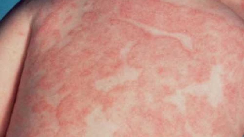Vết mẩn đỏ có thể là biểu hiện của các bệnh nguy hiểm