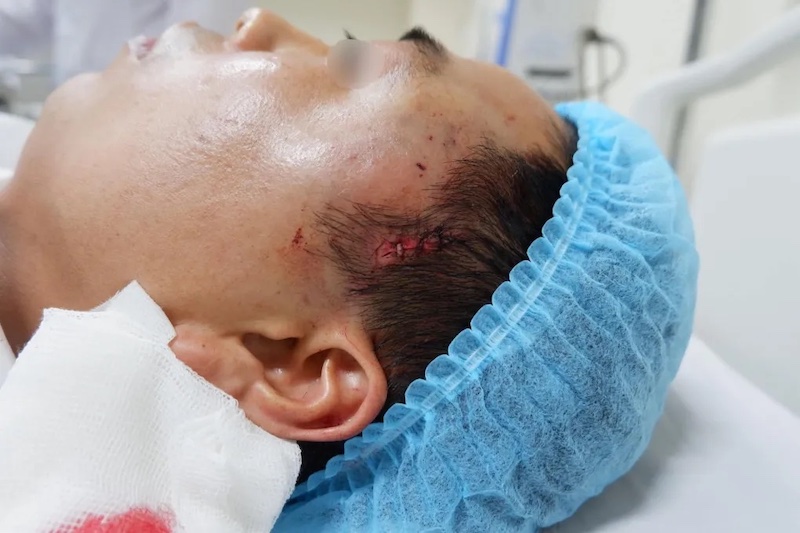 Độn thái dương chỉ an toàn khi bạn lựa chọn đúng cơ sở thẩm mỹ uy tín, thực hiện bởi các bác sĩ giỏi, có kinh nghiệm Độn thái dương chỉ an toàn khi bạn lựa chọn đúng cơ sở thẩm mỹ uy tín, thực hiện bởi các bác sĩ giỏi, có kinh nghiệm