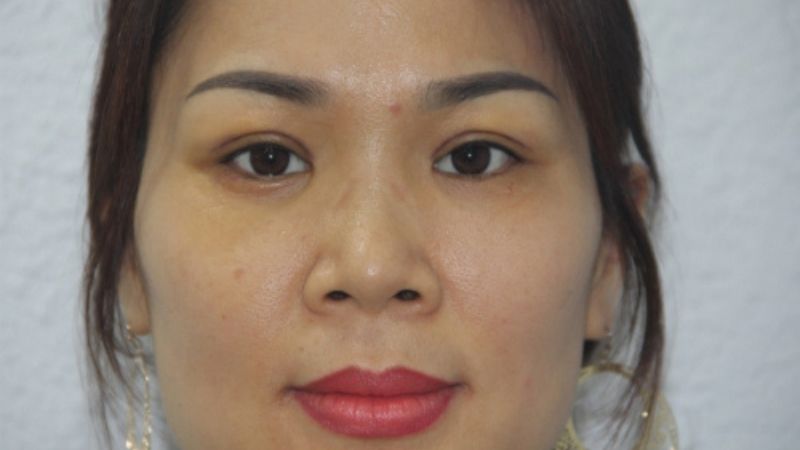 Mắt sâu là mắt như thế nào?