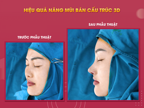Bạn có thể lựa chọn phương pháp phù hợp với dáng mũi