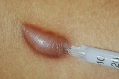 Tiêm sẹo lồi là một phương pháp điều trị sẹo lồi nhanh chóng, an toàn, có hiệu quả nhất ở các vết sẹo nhỏ, không có kéo, phì đại hay phức tạp.