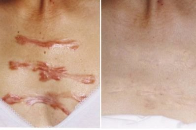 Sẹo lồi có thể điều trị nhưng sẽ không biến mất hoàn toàn. Với các phương pháp khoa học tiên tiến hiện nay, có thể khắc phục lên đến 90%