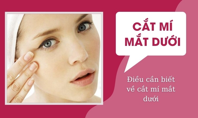 Cắt mí mắt dưới và những điều cần biết