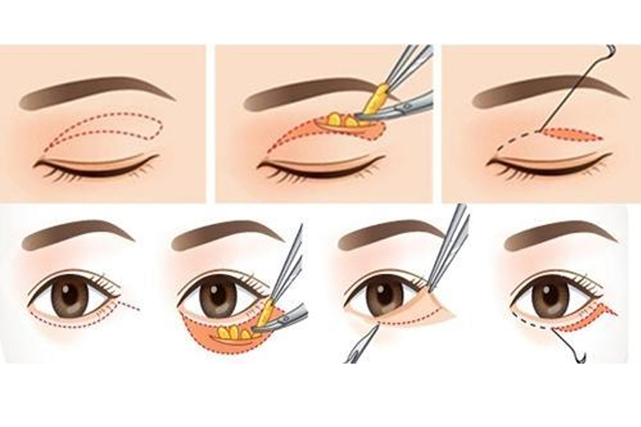 Phương pháp cắt mí Hàn Quốc không còn mắt 3 mí chỉ trong 1 lần thực hiện