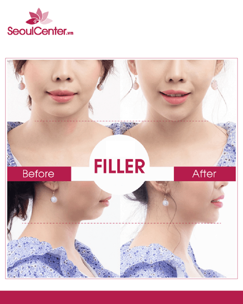 Kết quả tiêm filler cằm tại Viện Thẩm mỹ Seoul Center