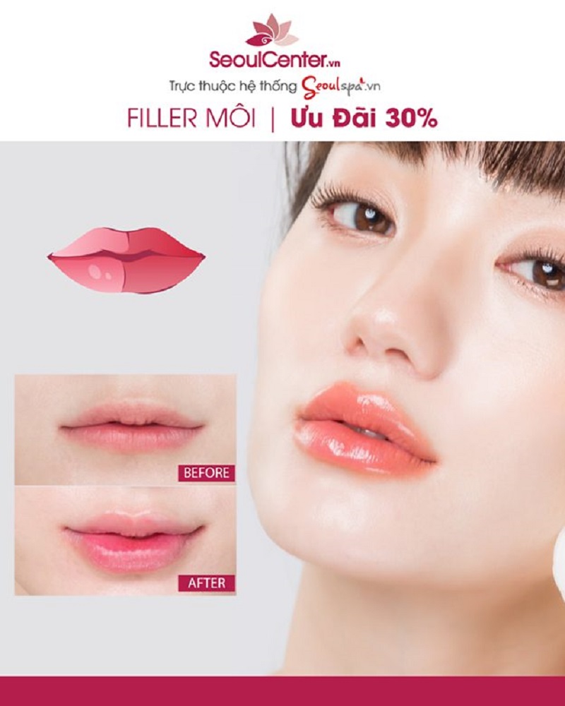 Ảnh thực tế sau khi tiêm filler mô tại Seoul Center