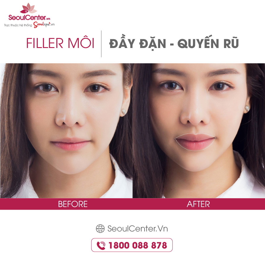 Tiêm filler môi tại Seoul Center đem đến kết quả làm đẹp lâu dài