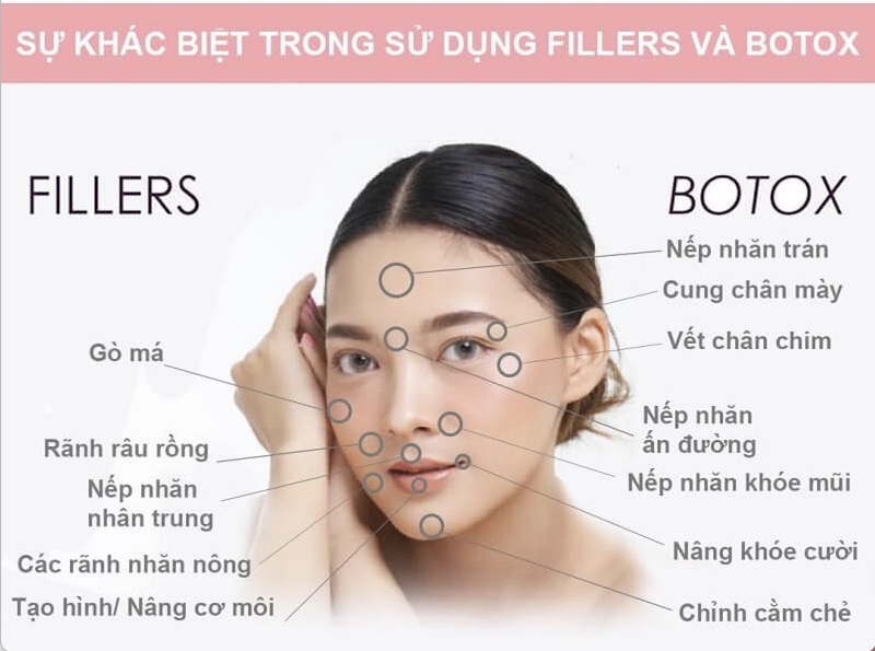 Filler là chất làm đầy còn botox là chất gây ức chế