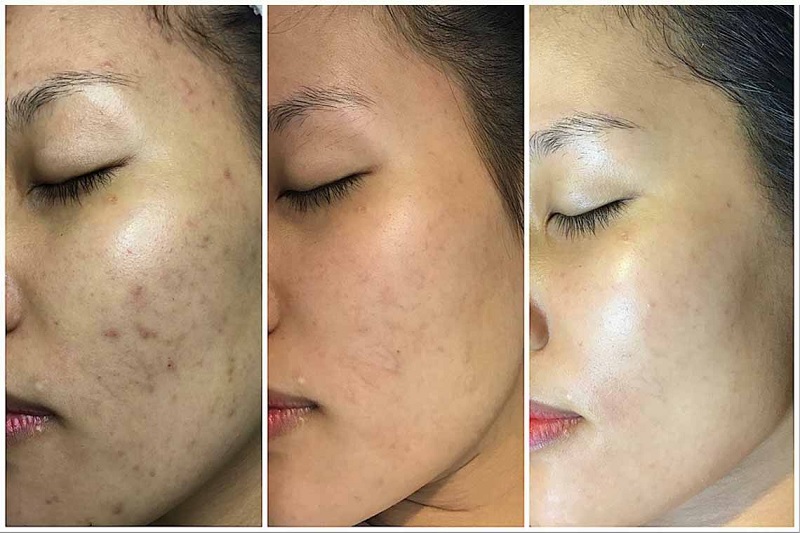 Làn da được cải thiện rõ rệt sau khi sử dụng tảo xoắn