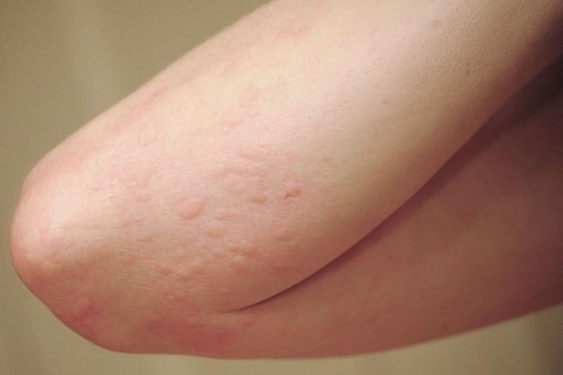 Ngứa, vàng da, nổi mề đay có thể là dấu hiệu cho thấy gan của bạn đang có vấn đề