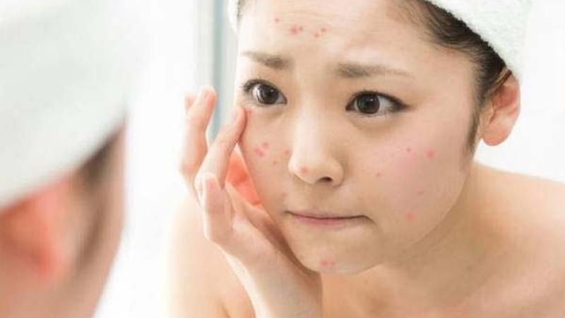 Những lưu ý quan trọng sau khi nặn mụn