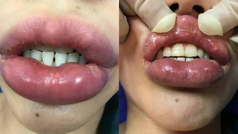 Filler môi có thể xuất hiện biến chứng sưng tấy và cương cứng nhiều ngày