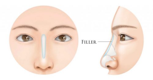 Tiêm filler mũi thông thường cần từ 1 – 2cc