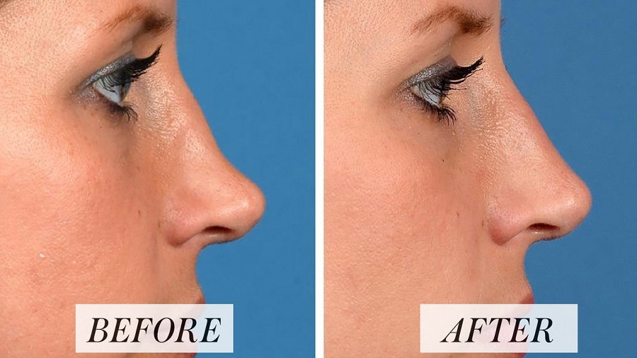 Chất lượng filler quyết định rất lớn đến kết quả tiêm filler mũi