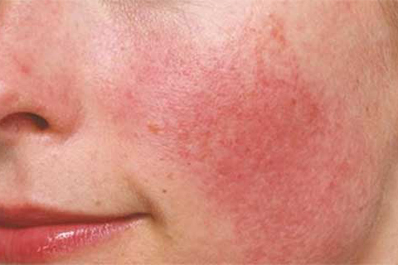Trường hợp dị ứng da sau khi tiêm botox