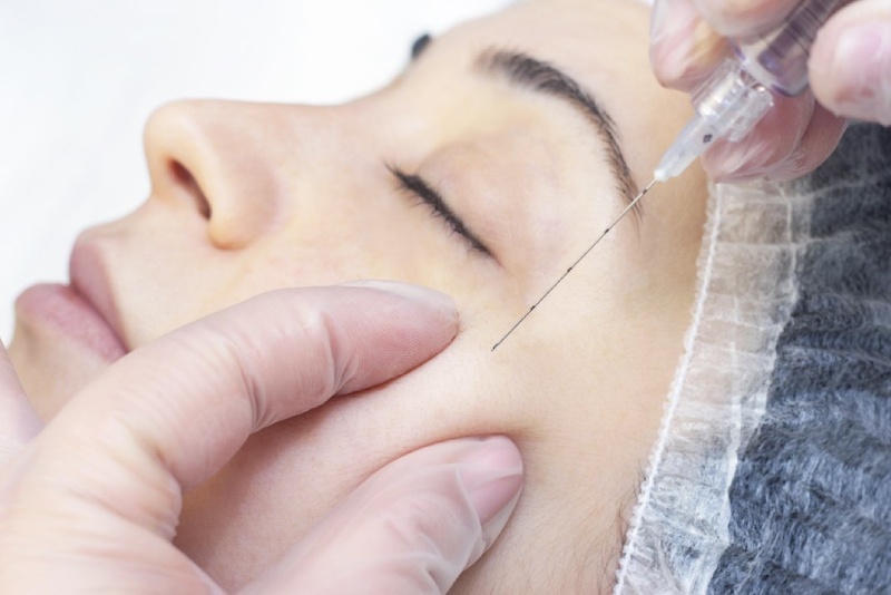 Tiêm filler là phương pháp làm đẹp được nhiều người yêu thích