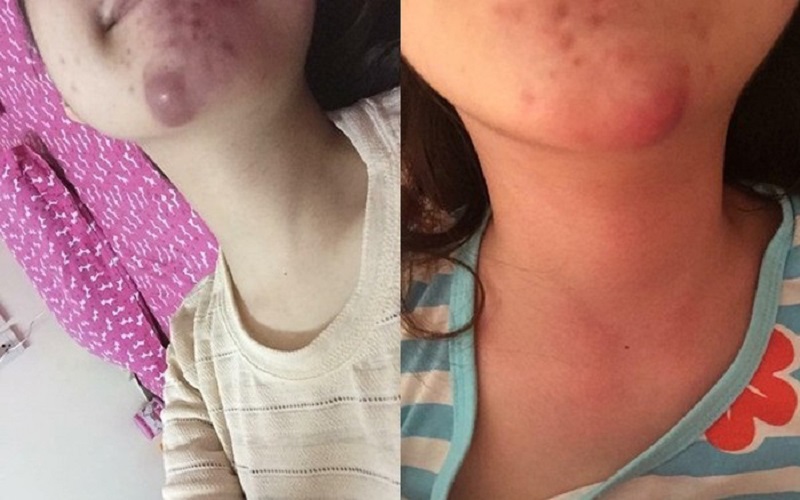 Tiêm filler cằm bị lỗi sẽ làm khuôn mặt mất cân đối