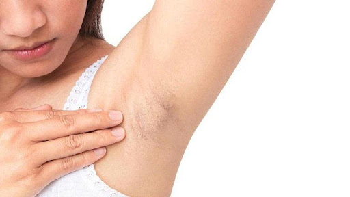 Có nên triệt lông là phương pháp giúp loại bỏ lông tại khu vực không mong muốn trên cơ thể