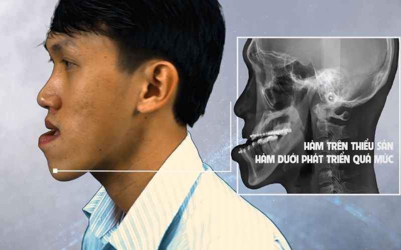 Đặc điểm của khuôn mặt lưỡi cày là có phần cằm dài và chìa ra ngoài