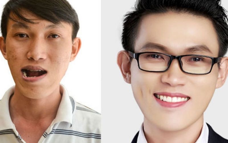 Hình ảnh khác biệt rõ rệt sau khi chỉnh sửa mặt