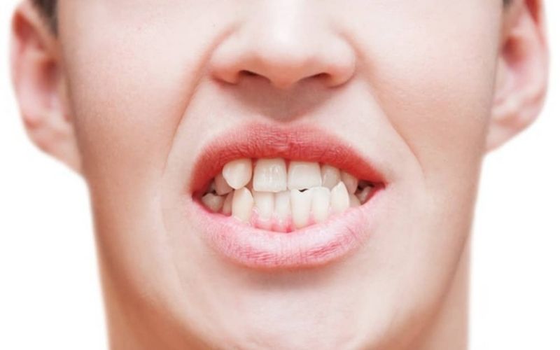 Hàm trên và hàm dưới không cân đối khiến cho chức năng nhai, nói bị ảnh hưởng