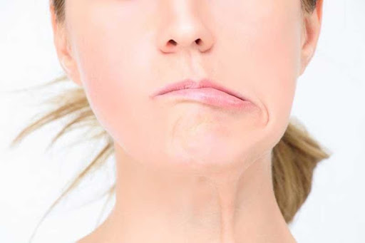 Mí mắt giật có thể là triệu chứng của bệnh lệch cơ mặt