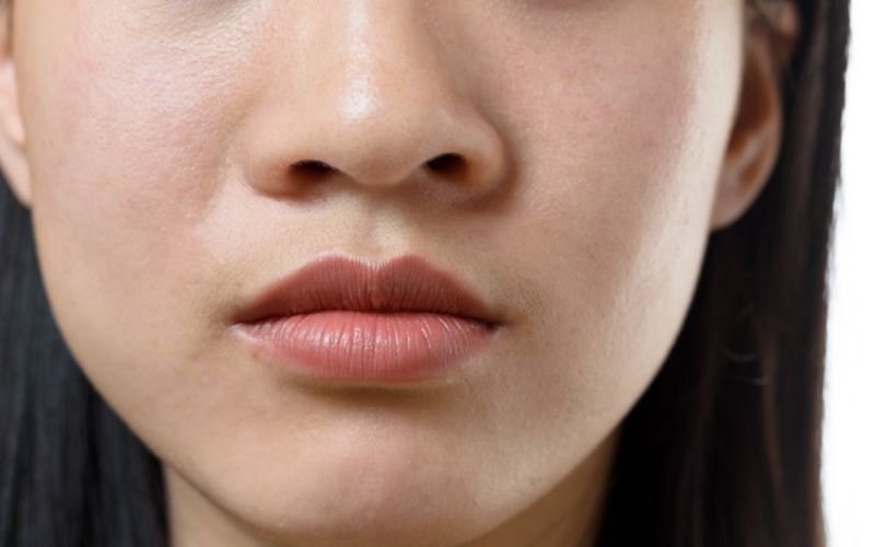 Cánh mũi to bè bẩm sinh khó có thể tác động khi cấu trúc mũi đã ổn định